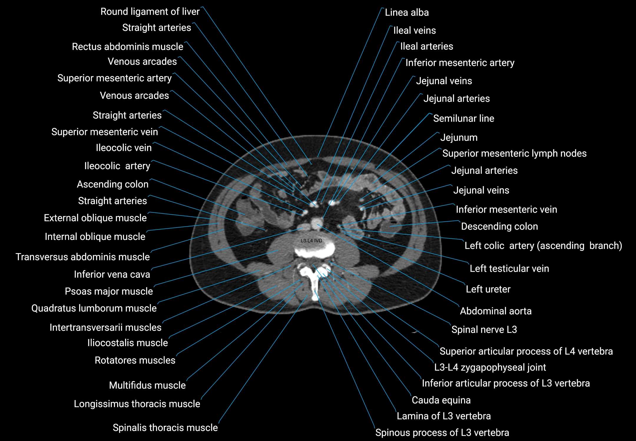 CT male pelvis axial cross sectional anatomy labelled radiology image -00097.webp